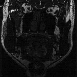 Imaging Features Of Intramuscular Cysticercosis Reviewed In Last Two