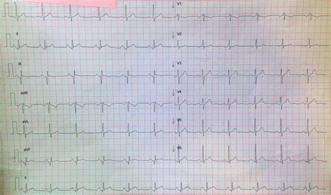 Miocarditis Rm Sociedad Española De Cardiología