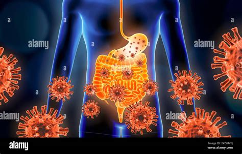 Gastroenteritis Of Stomach Flu 3d Rendering Illustration With Red Virus Cells And Human Body