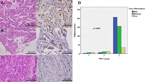 The Tumor Differentiation Grade Was Also Associated With Thyroid