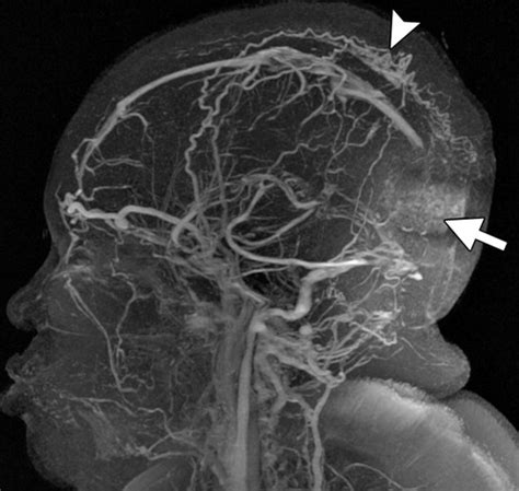 Intracranial Lesions With High Signal Intensity On T1 Weighted Mr