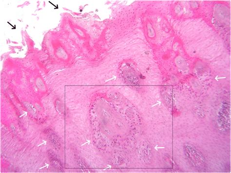 Histopathology Of Tongue Showing Desquamated Mucosal Epithelium Black