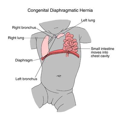 Congenital Diaphragmatic Hernia Types