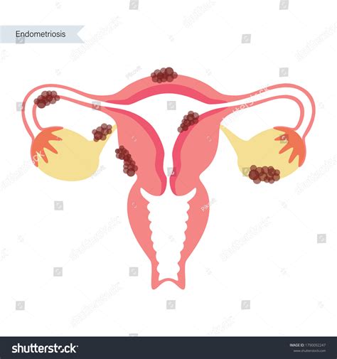 Cancer Myoma Endometriosis Uterus Woman Health Stock Vector Royalty