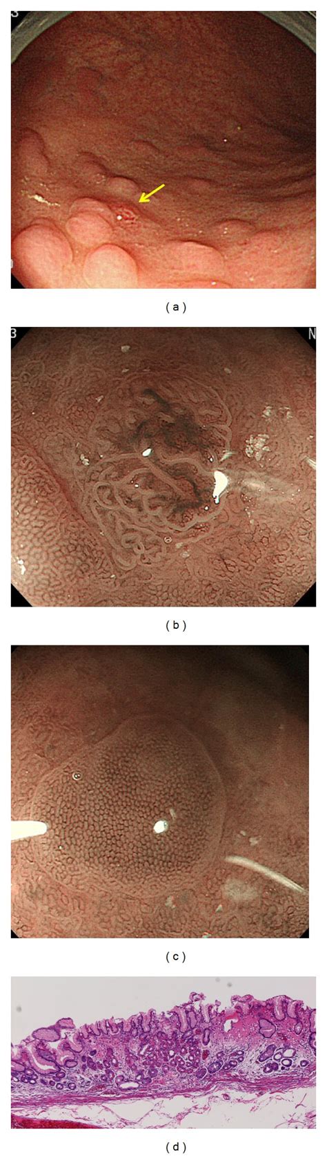 A Conventional Endoscopic Findings In Case 3 Yellow Arrow Shows A Download Scientific