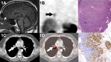 Ct And 111in Pentetreotide Spect Of Hilar Acth Producing Neuroendocrine