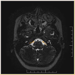 Abducens nerve- MRI - Sumer's Radiology Blog