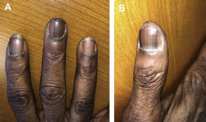 Melanoma Nail Bed Melanoma Of Nail Unit Subungual Melanoma Dermnet Nz