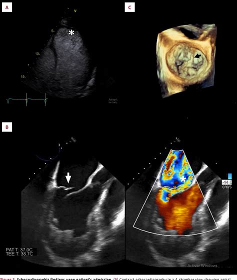 Figure 3 From Acute Mitral Regurgitation Due To Chordae Tendineae