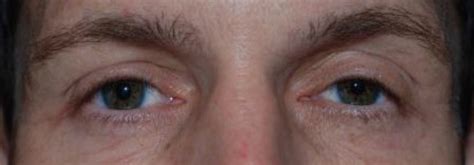 Ptosis Repair Before And After Patient 11 Oculus