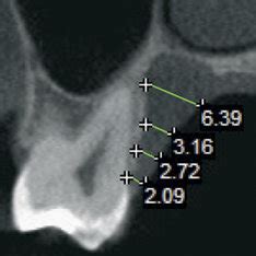 Representative Cone Beam Computerized Tomography Scan Showing Soft And