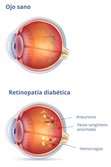 Retinopatía Diabética Clínica Oftalmológica Tetuán