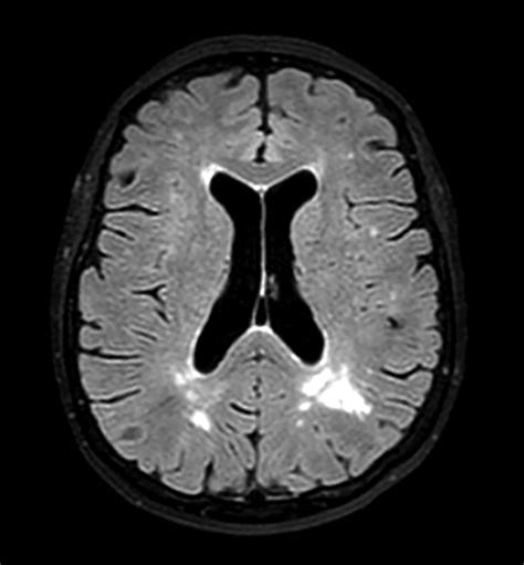 Amyloid Related Imaging Abnormalities An Update Ajr