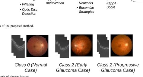 Figure 2 From Glaucoma Grading Using Multimodal Imaging And Multilevel