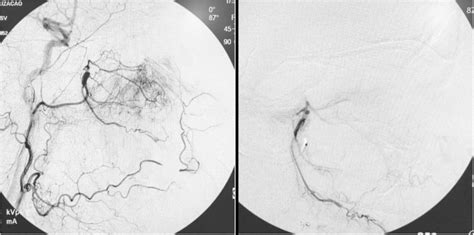 A Preembolization Arteriography B Postembolization Arteriography