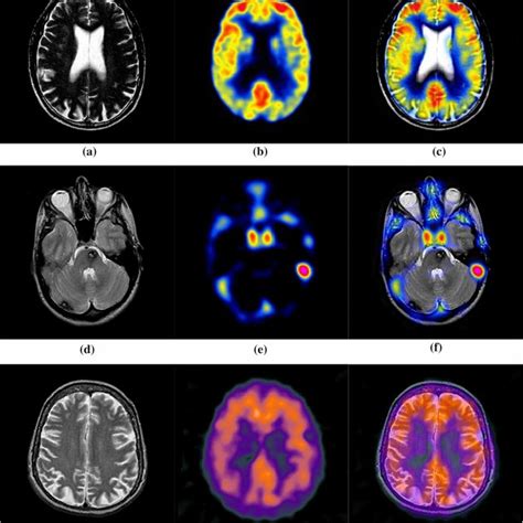 Multi Modality Medical Image Fusion By The Proposed Method The Left