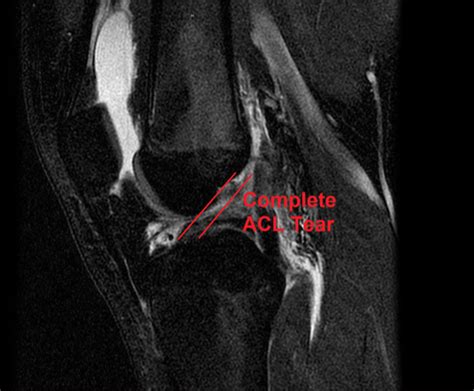 Acl Injuries Atlanta Bone And Joint Specialists