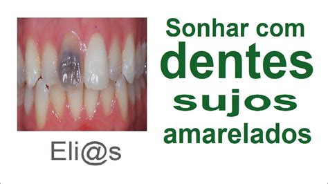 Sonhar Dentes Sujos Ou Amarela Dos Significado Youtube