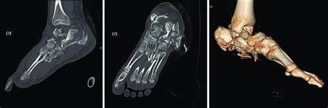 A Preoperative Ct Scan Sagittal View B Preoperative Ct Scan Download Scientific Diagram