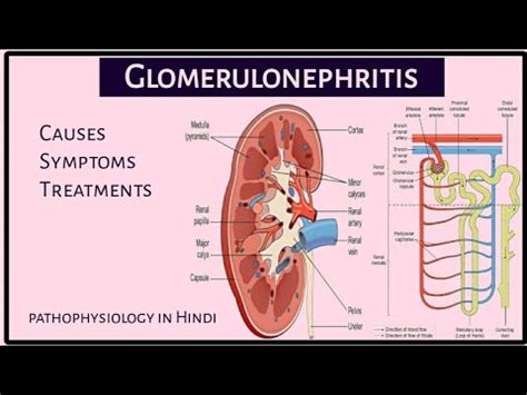 What Is Glomerulonephritis Causes Symptoms Treatment Enlarged Kidney