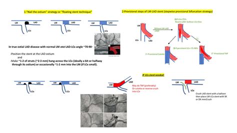 Isolated Ostial LAD Or Ostial LCx Stenting YouTube