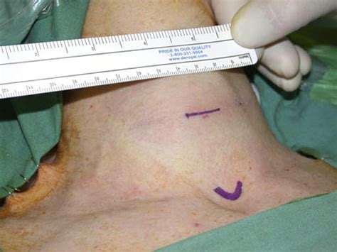 Minimally Invasive Video Assisted Thyroidectomy MIVAT Technique