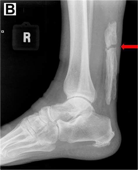 Acute Fracture Of Extensive Achilles Tendon Calcific Tendinopathy Hot Sex Picture