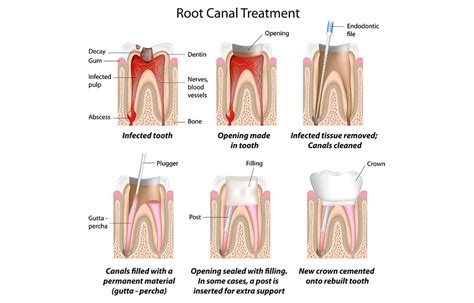 Root Canal Treatment Orangeville Tooth Buds Dentistry