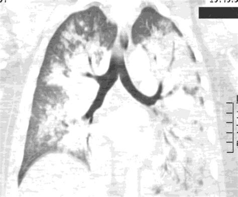 Ct Chest Coronal View Demonstrating Bilateral Diffuse Lung