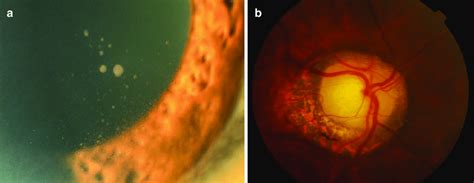 1 A Slit Lamp Photograph Of An Eye With Acute Recurrent Download