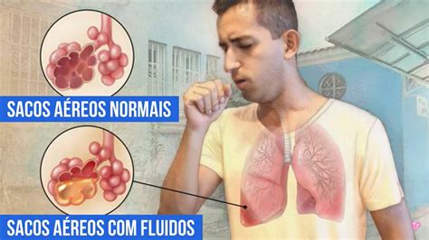 Derrame Pleural Tipos Causas Sintomas E Tratamento