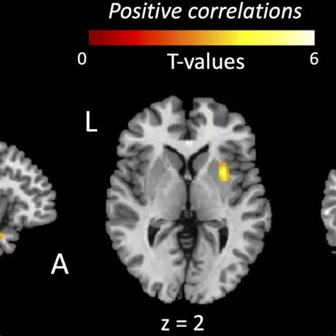 Functional Connectivity Of The Primary Motor Cortex Is Reduced In