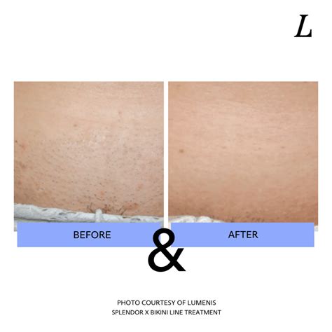 Brazilian Laser Hair Removal Versus Waxing Lumenis