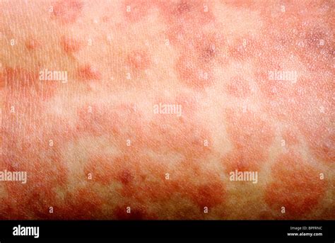 Maculopapular Rash Hi Res Stock Photography And Images Alamy