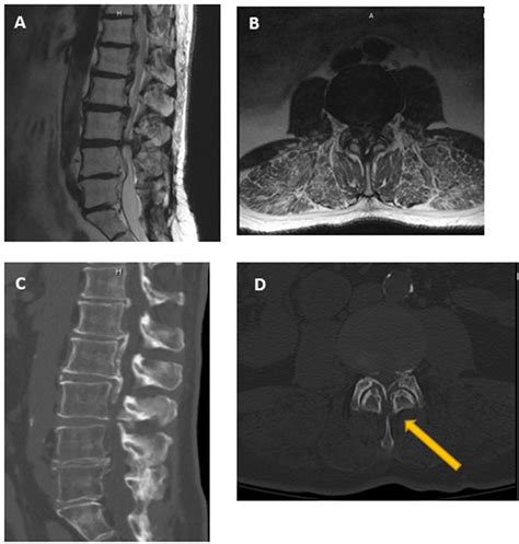 Lumbosacral Ct Radiology Key