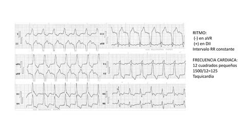 Electrocardiograma Ejercicios Pptx Descarga Gratuita