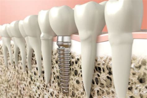 The Recovery Process after a Dental Bone Graft - Randal S. Elloway DDS, Inc Red Bluff California