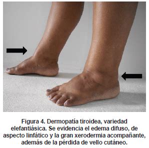 Mixedema