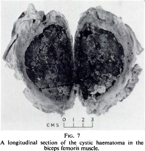 Figure 1 From The Haemophilic Pseudotumour Or Haemophilic Subperiosteal Haematoma Semantic Scholar