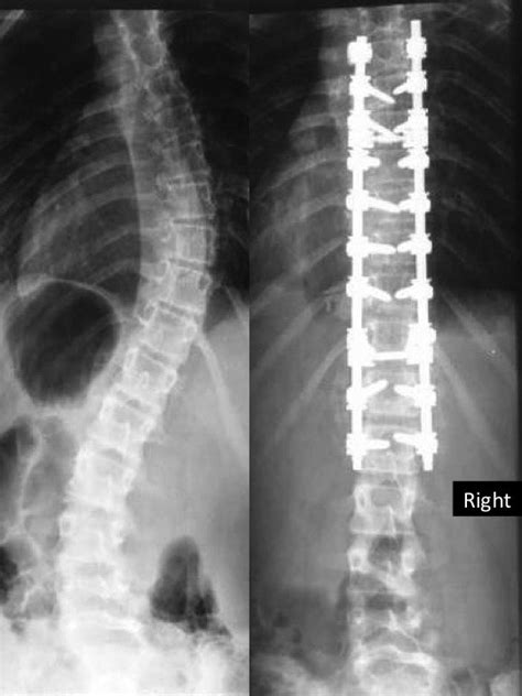 Standing Postero Anterior Preoperative Left And Postoperative Right