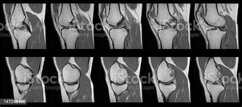 Torn Acl Mri Knee Scan Series Adult Human Female 照片檔及更多 電腦斷層掃描 照片