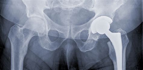 Hip Replacement Surgeries Crunching The Numbers London Bridge