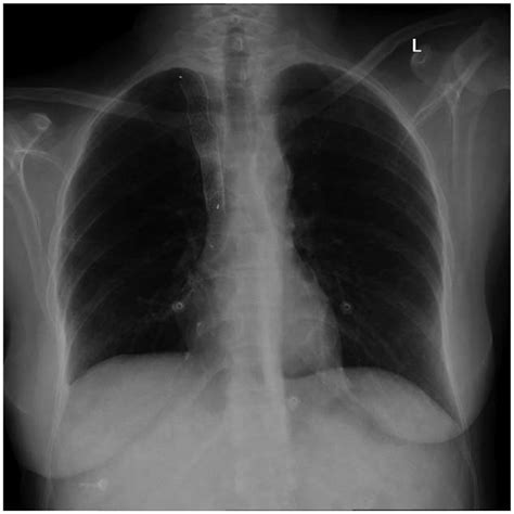 Chest X Ray Showing Covered Stent In The Superior Vena Cava Extending