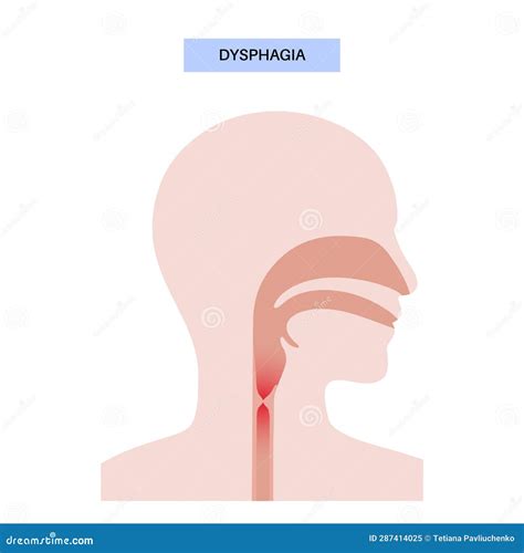 Dysphagia Medical Poster Vector Illustration Cartoondealer