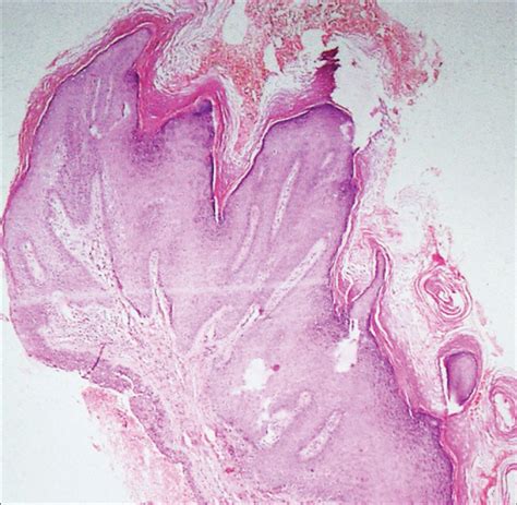 Contiguous Squamous Proliferations In Syringocystadenoma Papilliferum