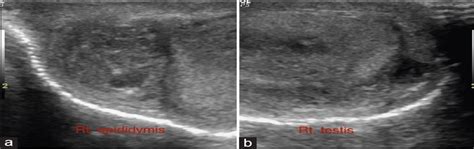 Classical Case Of Tuberculous Epididymo Orchitis And How To West