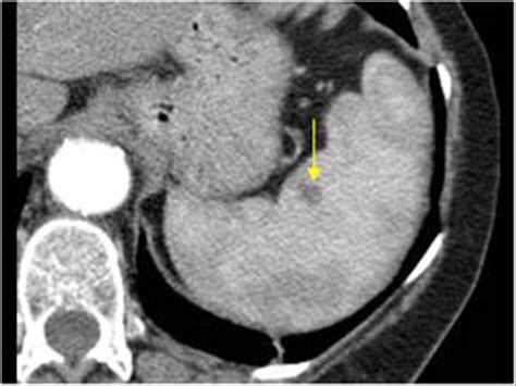 Abdomen And Retroperitoneum 14 Spleen Case 142 Benign Mass Lesion Of The Spleen