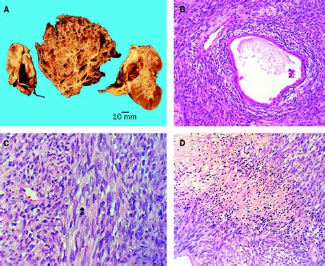 Aggressive Mixed Epithelial Stromal Tumour Of The Kidney Treated With