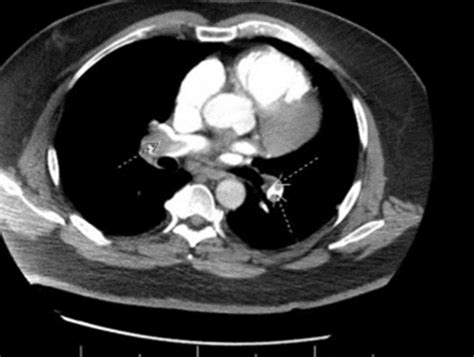 Percutaneous Right Atrial Thrombectomy Using Flow Triever (Inari) and ...