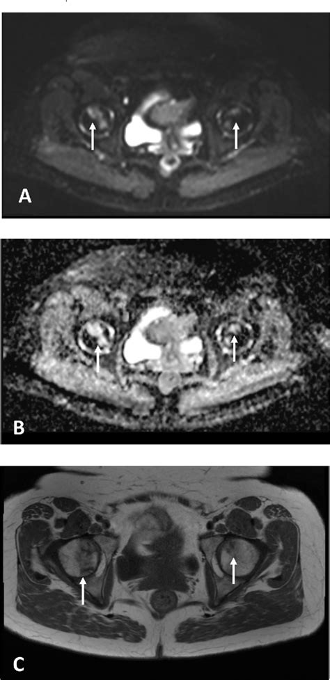 Figure 1 From Detection Of Avascular Necrosis On Routine Diffusion